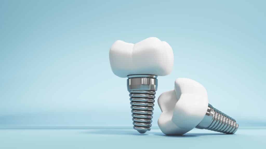 Discover All-on-4 Dental Implants for a Confident Smile